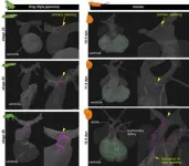 Origins of coronary arteries 3