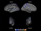 Orphanage care linked to thinner brain tissue in regions related to ADHD