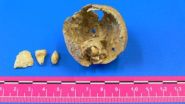 Ovarian tumor, with teeth and a bone fragment inside, found in a Roman-age skeleton