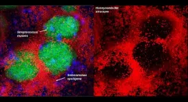 Penn Dental Medicine collaboration identifies new bacterial species involved in tooth decay