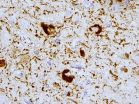 Penn study suggests another avenue for detecting Alzheimer's disease