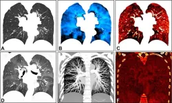 Photon-counting CT can evaluate lung function