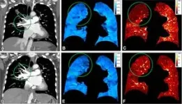 Photon-counting CT can evaluate lung function 2