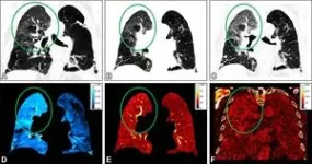 Photon-counting CT can evaluate lung function 3