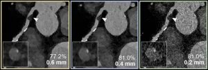 Photon-counting CT improves coronary artery disease assessment