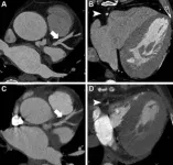 Photon-counting CT noninvasively detects heart disease in high-risk patients 2