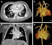 Photon-counting CT offers superior imaging in babies with heart defects