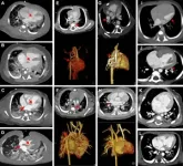 Photon-counting CT offers superior imaging in babies with heart defects 2