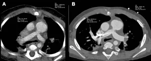 Photon-counting CT offers superior imaging in babies with heart defects 3