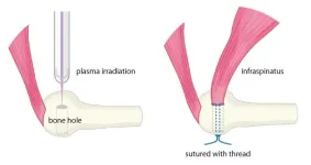 Pitchers rejoice? Plasma irradiation might prevent tendon re-tears