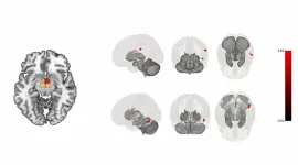 Post-bariatric surgery exercise modulates brain regions associated with regulation of food intake