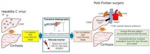 Post-Fontan liver fibrosis goes under the radar