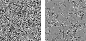 Potential drug target for difficult-to-treat breast cancer: RNA-binding proteins