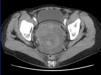 Potential target for reversing drug resistance in ovarian cancer identified 2