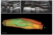 Presence of subclinical atherosclerosis is marker of mortality and its progression increases risk of death