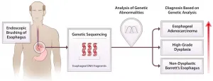 Procedures identify Barretts esophagus patients at risk for cancer progression