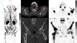 PSMA PET/CT waives the need for pre-imaging biopsy in elderly patients