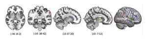 Psychedelic drug psilocybin changes brain connectivity to treat body dysmorphic disorder