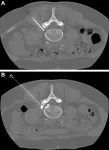 Pulsed radiofrequency with steroid injection brings sciatica relief