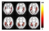 Quantitative volumetric analysis of the optic radiation in the normal human brain