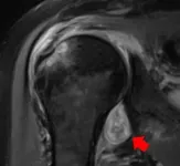 Radiological images confirm COVID-19 can cause the body to attack itself