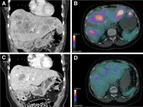 Radiopharmaceutical therapy controls symptoms and reduces medications in insulinoma patients