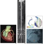 Rapid onsite FFR-CT algorithm helps facilitates clinical adoption