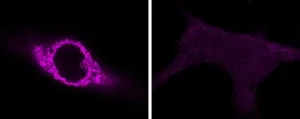 Rare disease’s DNA-damaging mutation could have consequences for more common conditions