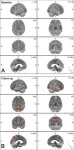 Recurrent brain trauma may increase Alzheimer’s risk 2