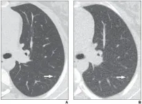 Reduced vs. standard CT dose for lung nodules in children, young adults with cancer