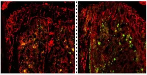 RESEARCH ALERT: City of Hope scientists unravel how TET2 gene deficiency fuels development of acute myeloid leukemia