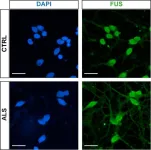 Research reveals the scale of disorder underpinning Motor Neurone Disease