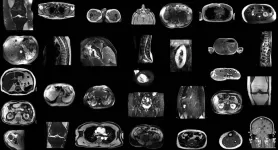 Researchers develop AI model to automatically segment MRI images