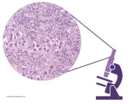 Researchers ID biomarkers of response to immunotherapy for kidney cancer