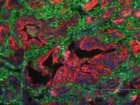 Researchers identify protein linked to metastasis in pancreatic cancer