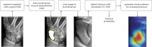 Researchers use AI to detect wrist fractures