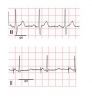 Researchers use iPSCs to define optimal treatment for managing life-threatening arrhythmias