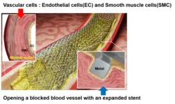 Revolutionizing stent surgery for cardiovascular diseases with laser patterning technology