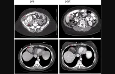 Riluzole and Sorafenib in patients with advanced solid tumors: a Phase I trial