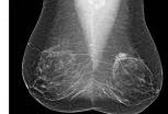 Risk-based screening misses breast cancers in women in their forties