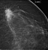 Risk-based screening misses breast cancers in women in their forties 2