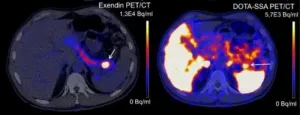 Scan based on lizard saliva detects rare tumor