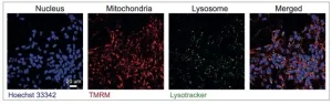 Scientists harness the power of AI to shed light on different types of Parkinson’s disease