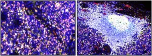 Scientists identify a new cancer immunotherapy target: Dysfunctional B cells