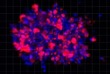 Scientists use organoid model to identify potential new pancreatic cancer treatment