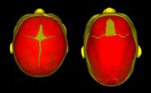 Seattle Childrens Research Institute helps identify causes of sagittal craniosynostosis