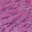 Second-most common breast cancer subtype may benefit from personalized treatment approach 2