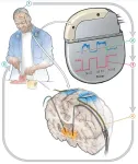 Self-adjusting brain pacemaker may help reduce Parkinson’s disease symptoms