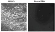 Sickle cells show potential to attack aggressive cancer tumors