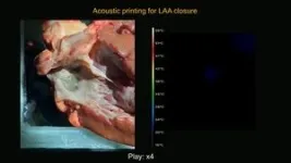 Soundwaves harden 3D-printed treatments in deep tissues 3